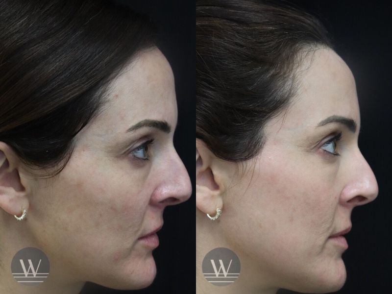 before and after laser skin resurfacing side face view case 7415