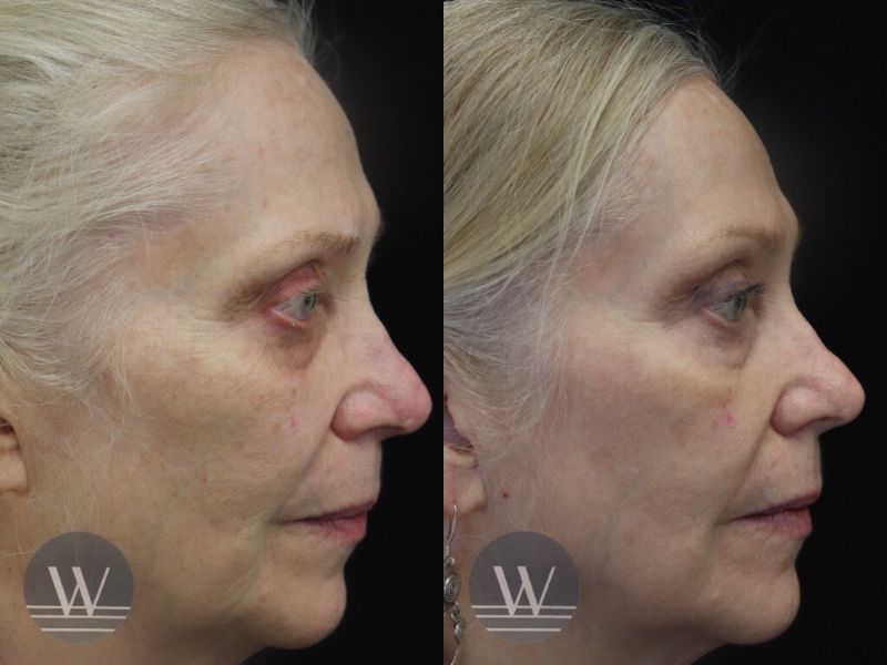 before and after laser skin resurfacing side face view case 7417
