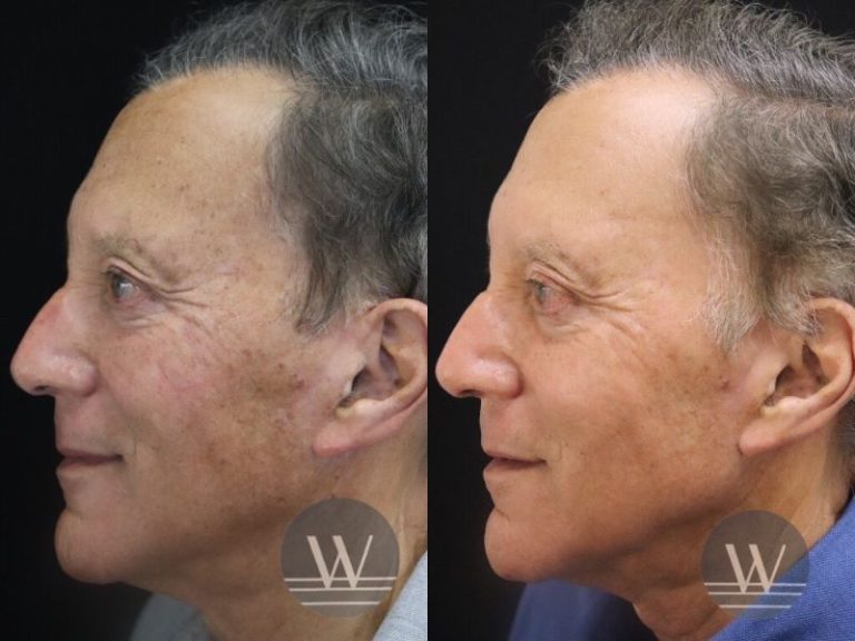 before and after laser skin resurfacing side face view case 7398
