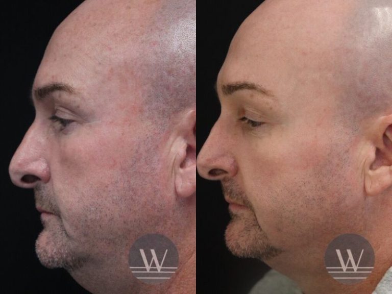 before and after laser skin resurfacing side face view case 7419