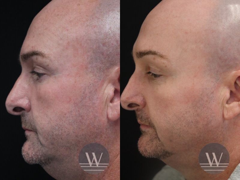 before and after laser skin resurfacing side face view case 7419
