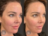 before and after laser skin resurfacing right angle face view case 7442
