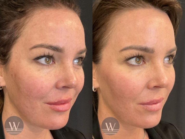 before and after laser skin resurfacing right angle face view case 7442