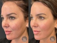 before and after laser skin resurfacing angle face view case 7443