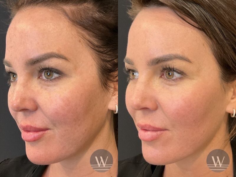 before and after laser skin resurfacing angle face view case 7443