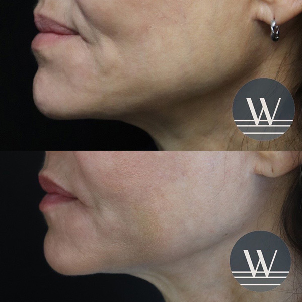 before and after skin tightening side view case 7445