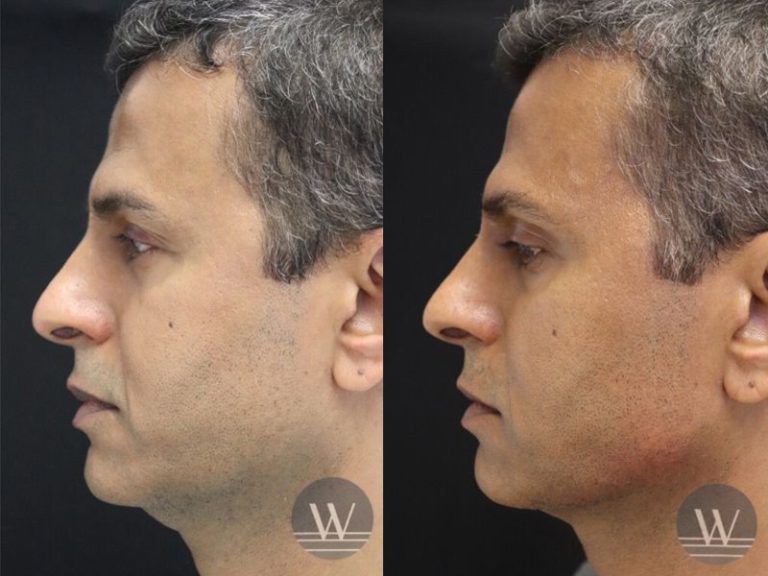before and after face procedure left side view case 7540