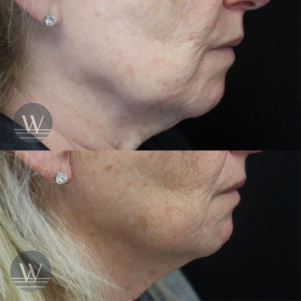 before and after neck skin tightening right side view case 7608
