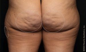 before aveli cellulite treatment back view case 7879