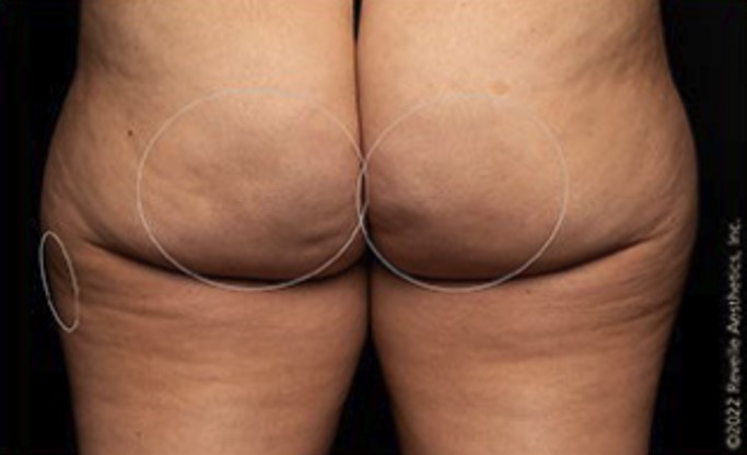 after aveli cellulite treatment back view case 7879