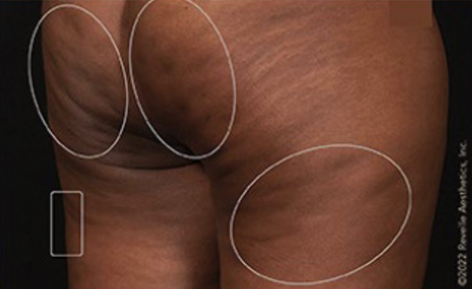 before aveli cellulite treatment angle view case 7886