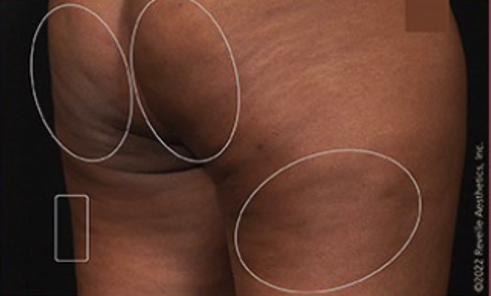 after aveli cellulite treatment angle view case 7886