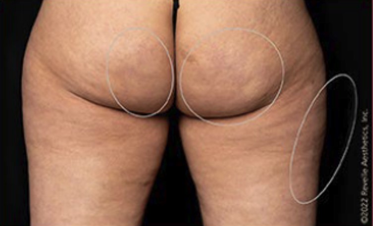 after aveli cellulite treatment back view case 7899