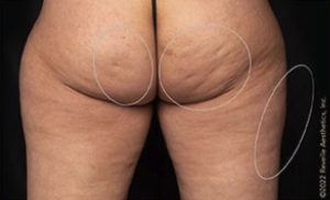before aveli cellulite treatment back view case 7899