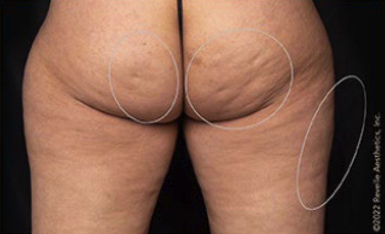before aveli cellulite treatment back view case 7899